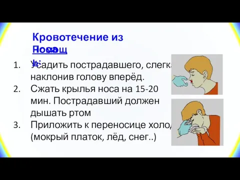 Усадить пострадавшего, слегка наклонив голову вперёд. Сжать крылья носа на 15-20 мин.