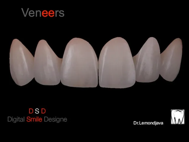 Veneers D S D Digital Smile Designe Dr.Lemondjava