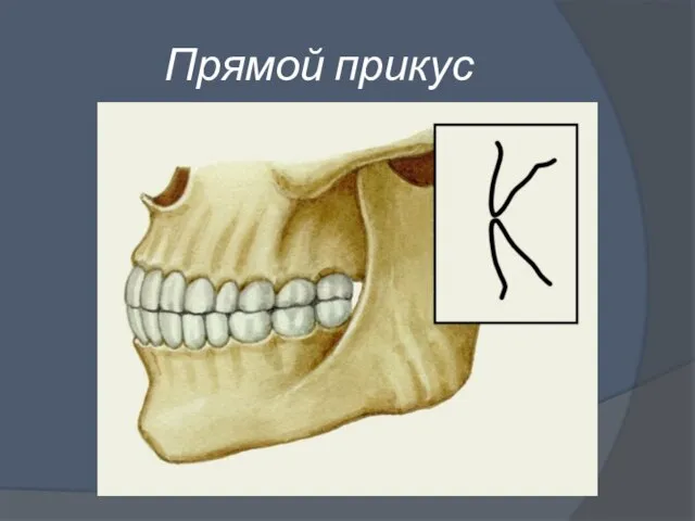 Прямой прикус