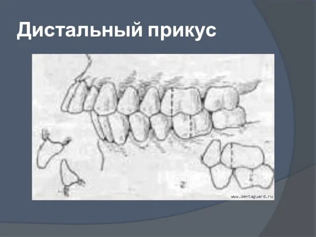 Дистальный прикус