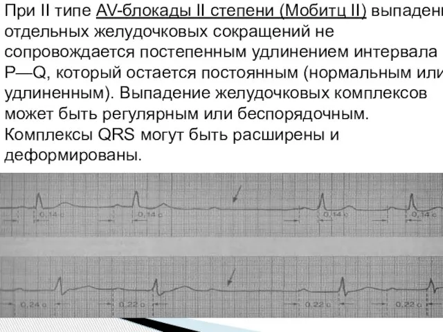 При II типе AV-блокады II степени (Мобитц II) выпадение отдельных желудочковых сокращений