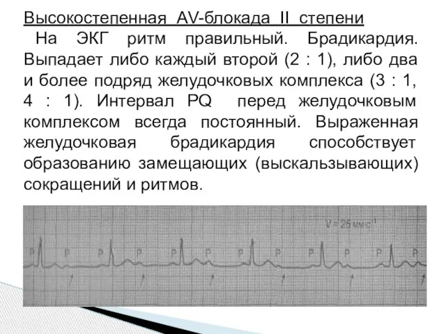 Высокостепенная АV-блокада II степени На ЭКГ ритм правильный. Брадикардия. Выпадает либо каждый