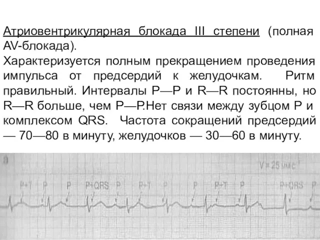 Атриовентрикулярная блокада III степени (полная AV-блокада). Характеризуется полным прекращением проведения импульса от