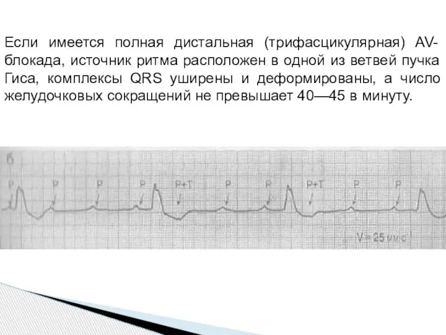 Если имеется полная дистальная (трифасцикулярная) AV-блокада, источник ритма расположен в одной из