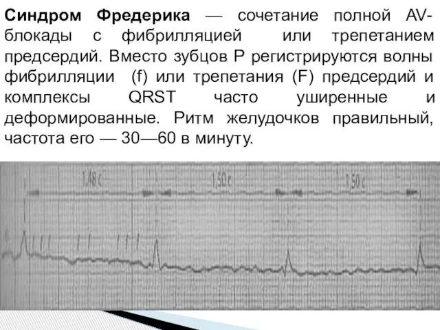 Синдром Фредерика — сочетание полной AV-блокады с фибрилляцией или трепетанием предсердий. Вместо