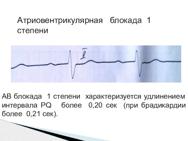 AВ блокада 1 степени характеризуется удлинением интервала PQ более 0,20 сек (при