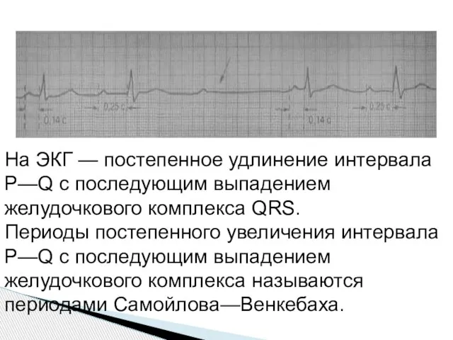 На ЭКГ — постепенное удлинение интервала Р—Q с последующим выпадением желудочкового комплекса