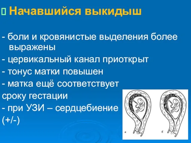 Начавшийся выкидыш - боли и кровянистые выделения более выражены - цервикальный канал