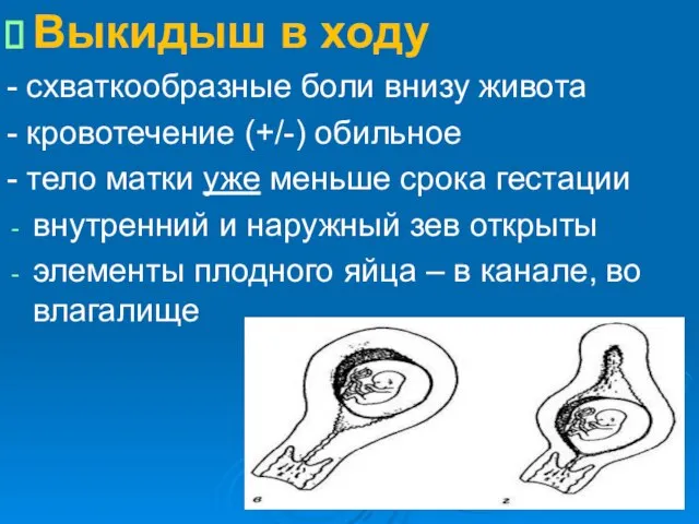 Выкидыш в ходу - схваткообразные боли внизу живота - кровотечение (+/-) обильное