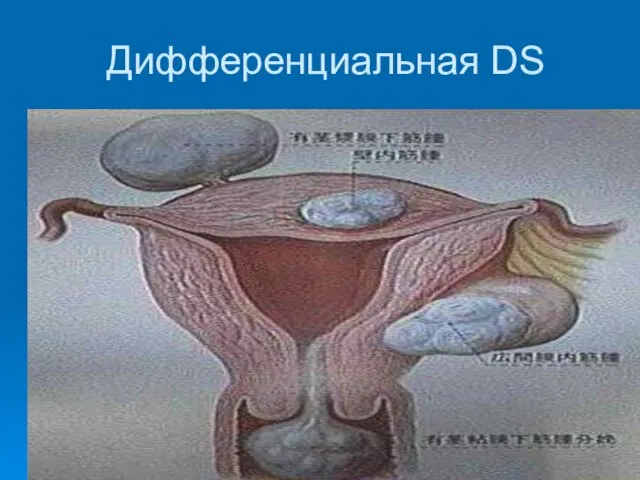 Дифференциальная DS