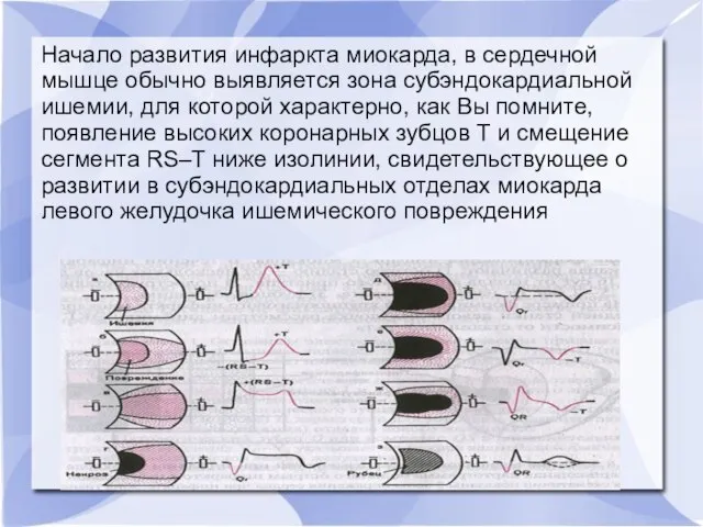 Начало развития инфаркта миокарда, в сердечной мышце обычно выявляется зона субэндокардиальной ишемии,