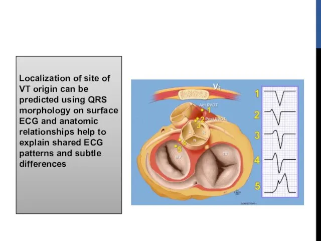 Localization of site of VT origin can be predicted using QRS morphology