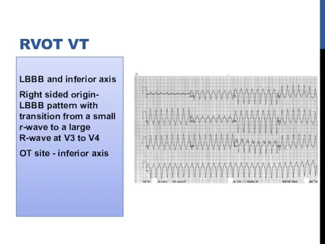 LBBB and inferior axis Right sided origin- LBBB pattern with transition from