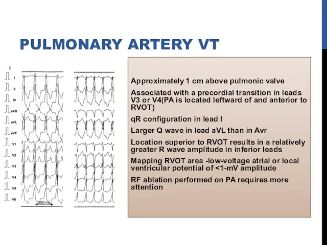 Approximately 1 cm above pulmonic valve Associated with a precordial transition in