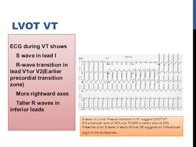 ECG during VT shows S wave in lead I R-wave transition in