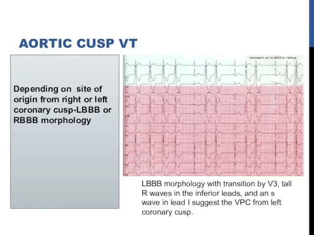 Depending on site of origin from right or left coronary cusp-LBBB or