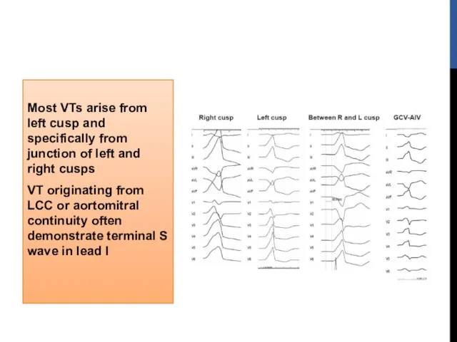 Most VTs arise from left cusp and specifically from junction of left