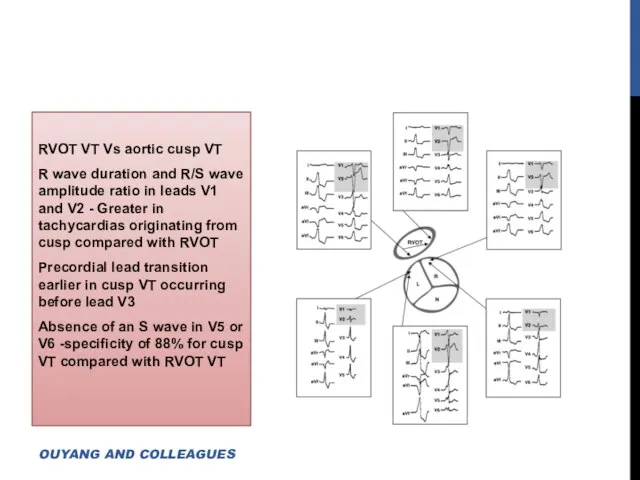 RVOT VT Vs aortic cusp VT R wave duration and R/S wave