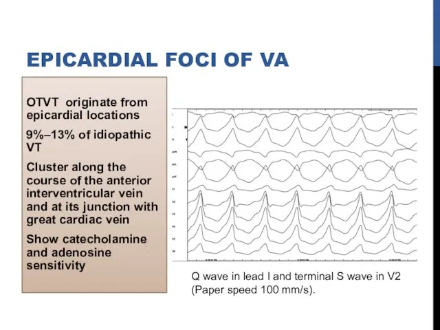 OTVT originate from epicardial locations 9%–13% of idiopathic VT Cluster along the