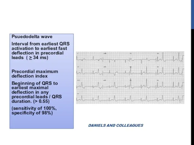 Psuedodelta wave Interval from earliest QRS activation to earliest fast deflection in