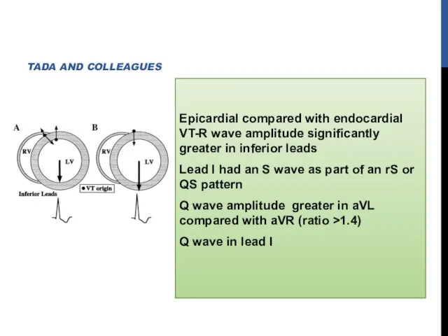 Epicardial compared with endocardial VT-R wave amplitude significantly greater in inferior leads