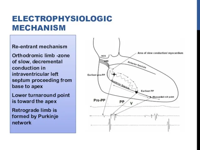 Re-entrant mechanism Orthodromic limb -zone of slow, decremental conduction in intraventricular left