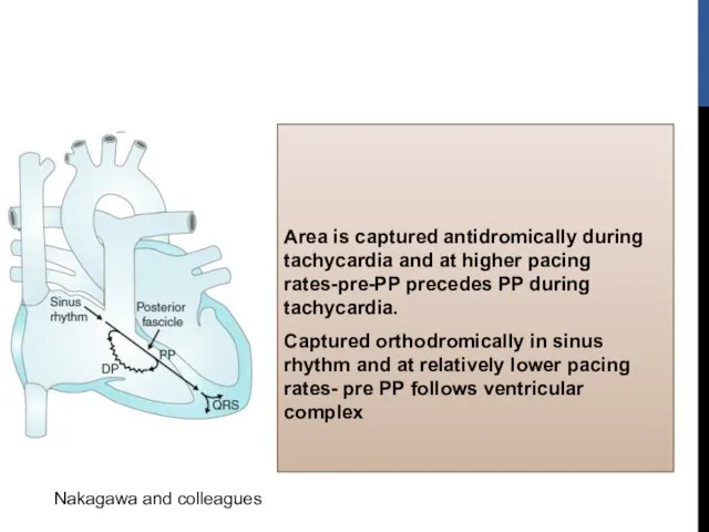 Area is captured antidromically during tachycardia and at higher pacing rates-pre-PP precedes