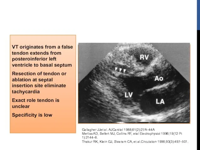 VT originates from a false tendon extends from posteroinferior left ventricle to