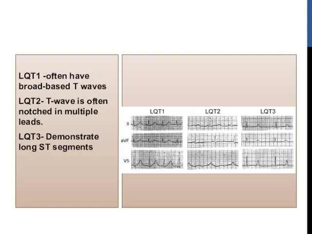 LQT1 -often have broad-based T waves LQT2- T-wave is often notched in