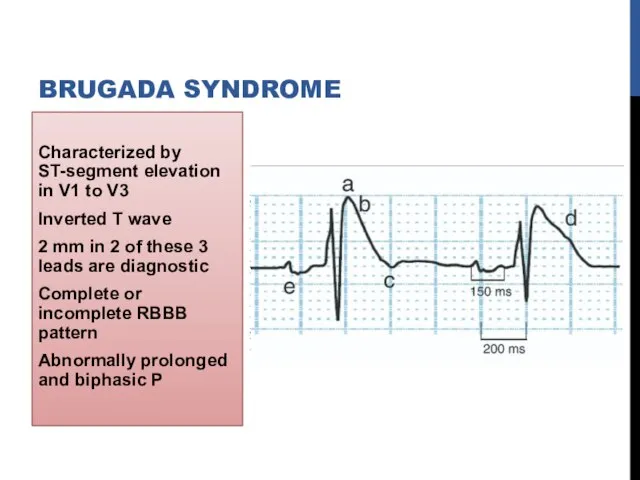 Characterized by ST-segment elevation in V1 to V3 Inverted T wave 2