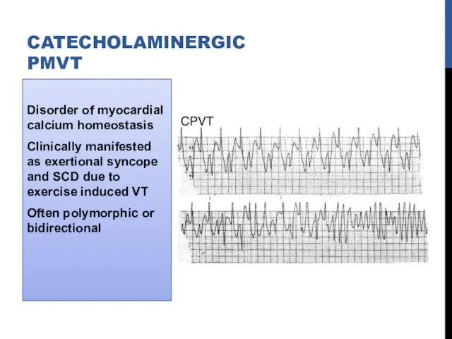 Disorder of myocardial calcium homeostasis Clinically manifested as exertional syncope and SCD