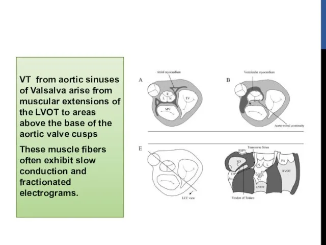 VT from aortic sinuses of Valsalva arise from muscular extensions of the