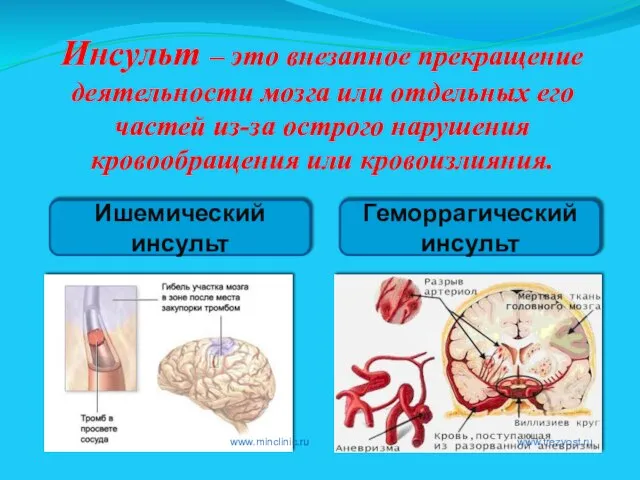 Инсульт – это внезапное прекращение деятельности мозга или отдельных его частей из-за