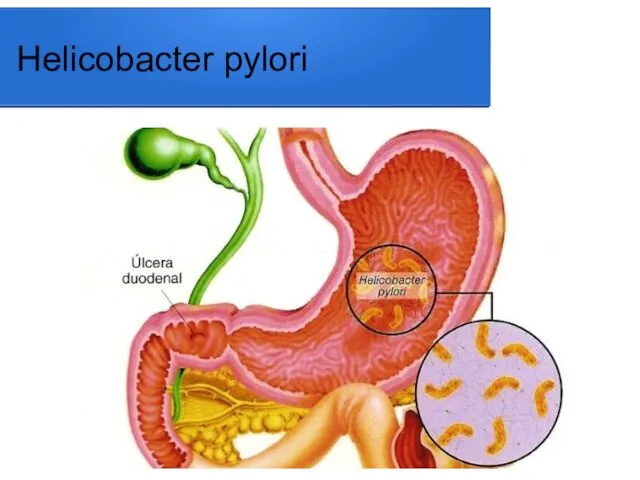 Helicobacter pylori