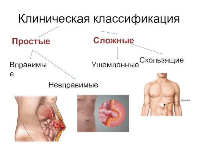 Клиническая классификация Простые Сложные Вправимые Невправимые Ущемленные Скользящие