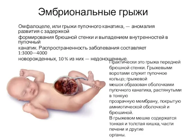 Эмбриональные грыжи Омфалоцеле, или грыжи пупочного канатика, — аномалия развития с задержкой