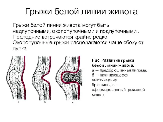 Грыжи белой линии живота Грыжи белой линии живота могут быть надпупочными, околопупочными