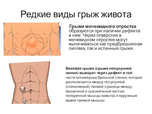 Редкие виды грыж живота Грыжи мечевидного отростка образуются при наличии дефекта в