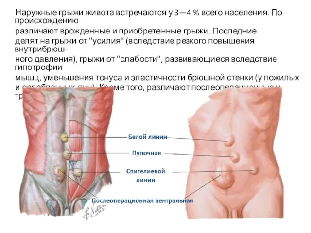 Наружные грыжи живота встречаются у 3—4 % всего населения. По происхождению различают