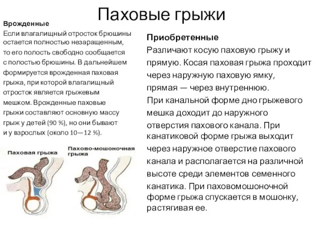 Паховые грыжи Врожденные Если влагалищный отросток брюшины остается полностью незаращенным, то его