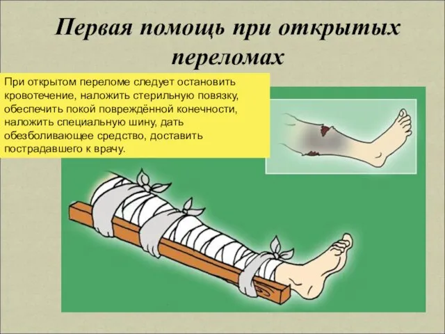 Первая помощь при открытых переломах При открытом переломе следует остановить кровотечение, наложить