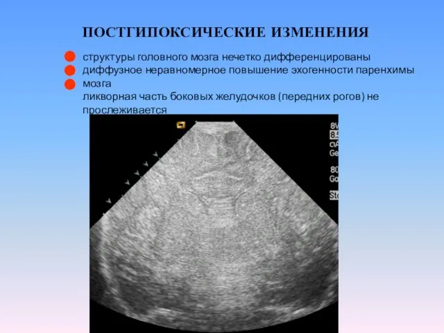 ПОСТГИПОКСИЧЕСКИЕ ИЗМЕНЕНИЯ структуры головного мозга нечетко дифференцированы диффузное неравномерное повышение эхогенности паренхимы