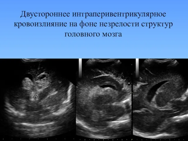 Двустороннее интраперивентрикулярное кровоизлияние на фоне незрелости структур головного мозга