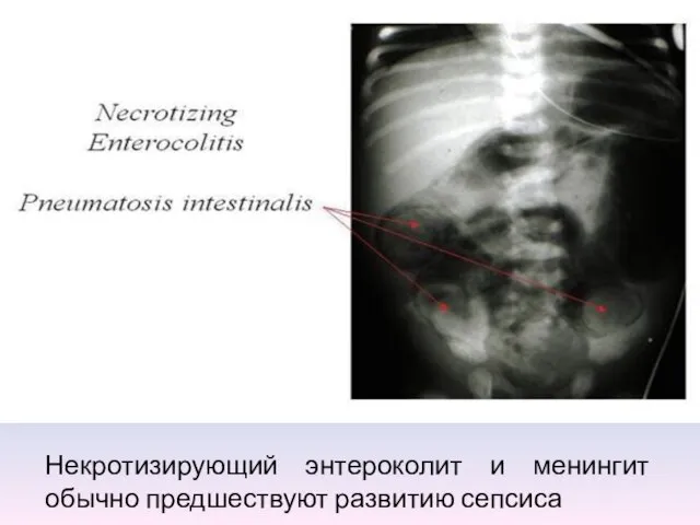 Некротизирующий энтероколит и менингит обычно предшествуют развитию сепсиса