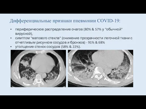 Дифференциальные признаки пневмонии COVID-19: периферическое распределение очагов (80% & 57% у "обычной"