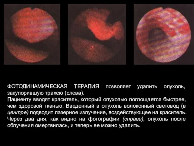 ФОТОДИНАМИЧЕСКАЯ ТЕРАПИЯ позволяет удалить опухоль, закупорившую трахею (слева). Пациенту вводят краситель, который