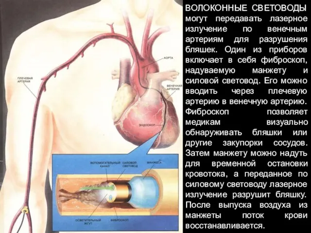 ВОЛОКОННЫЕ СВЕТОВОДЫ могут передавать лазерное излучение по венечным артериям для разрушения бляшек.