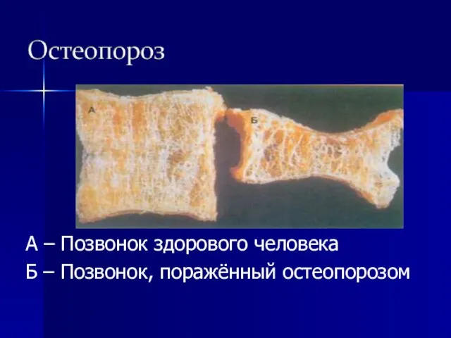 А – Позвонок здорового человека Б – Позвонок, поражённый остеопорозом