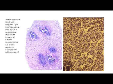 Эмболический гнойный нефрит. При исследовании под лупой в корковом и мозговом веществе