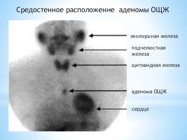 Средостенное расположение аденомы ОЩЖ околоушная железа подчелюстная железа щитовидная железа аденома ОЩЖ сердце